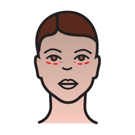 پروتز زیر چشم