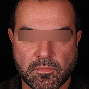 تصویر تخلیه بوکال فت بعد جراحی