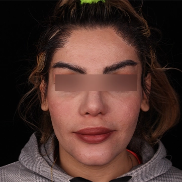 بعد جراحی پروتز گونه