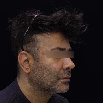 تصویر جراحی پروتز گونه