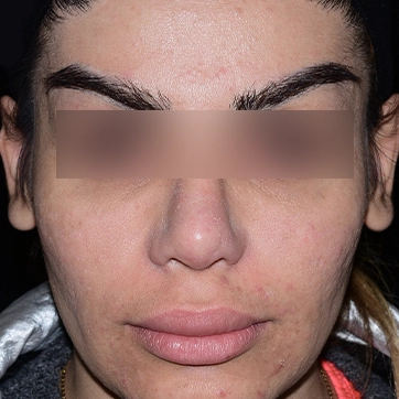 جراحی پروتز گونه قبل جراحی