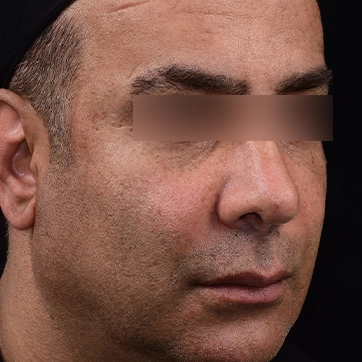 تصویر قبل جراحی پروتز گونه