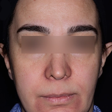 تصویر قبل جراحی پروتز گونه