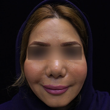 عمل لیفت گونه تصویر بعد جراحی