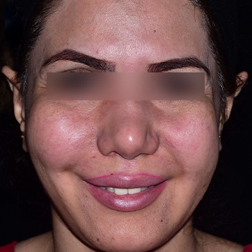 عمل لیفت گونه تصویر بعد جراحی