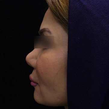 عمل لیفت گونه تصویر قبل جراحی