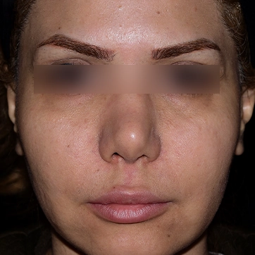 عمل لیفت گونه تصویر قبل جراحی