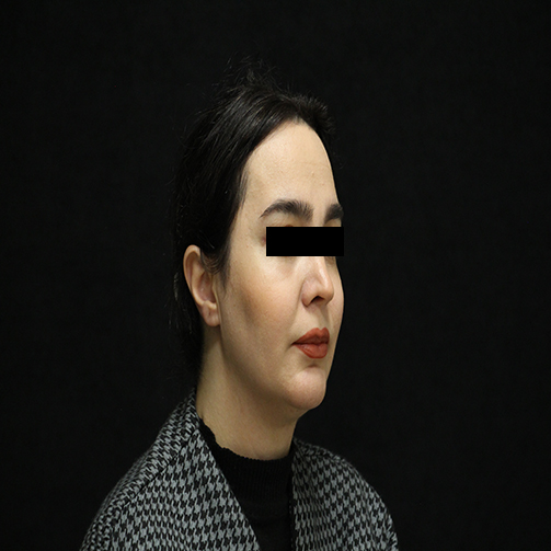تصویر زیباجو بعد جراحی زاویه سازی صورت