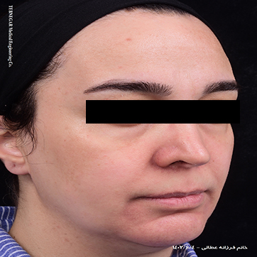 تصویر زیباجو قبل جراحی زاویه سازی صورت