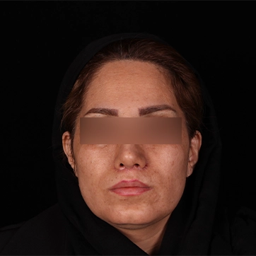 بزرگ کردن لب بعد