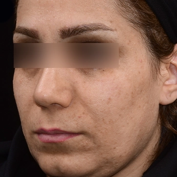 لیفت سانترال لب قبل