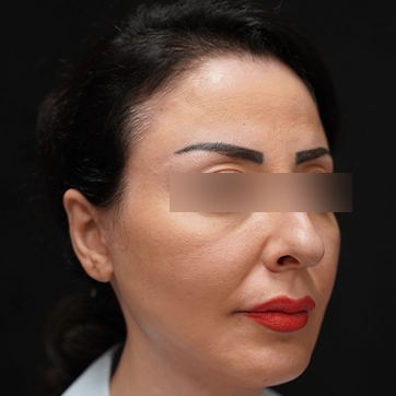 لیفت صورت بعد جراحی