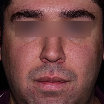 کوچک کردن دهان تصویر قبل