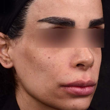 کوچک کردن دهان عکس قبل