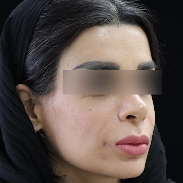 کوچک کردن دهان عکس بعد