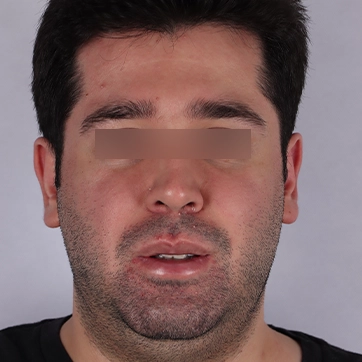 کوچک کردن دهان تصویر بعد