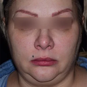 لیپوماتیک غبغب