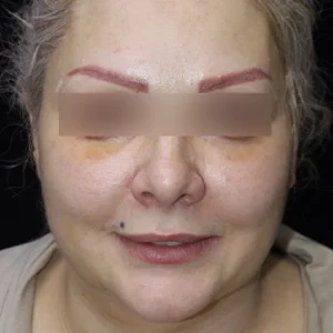 لیپوماتیک غبغب