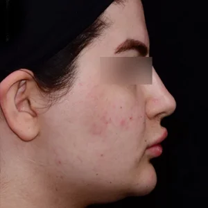 لیپوماتیک غبغب