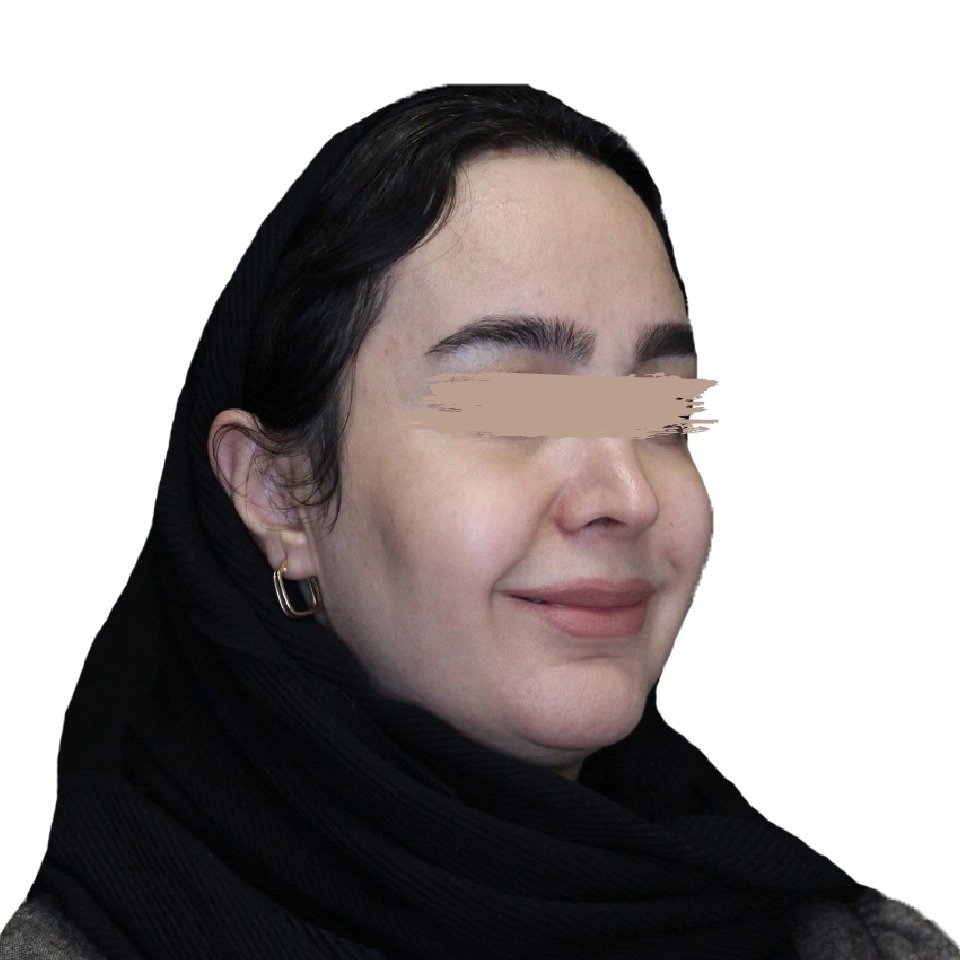 پروتز گونه