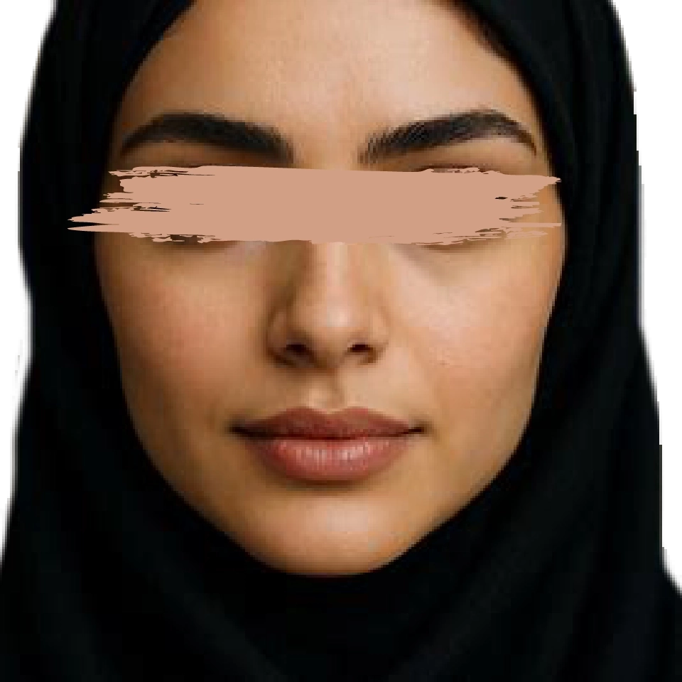 لیفت مستقیم لب بالا و پایین