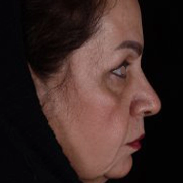 بلفاروپلاستی