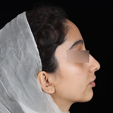 زاویه سازی صورت