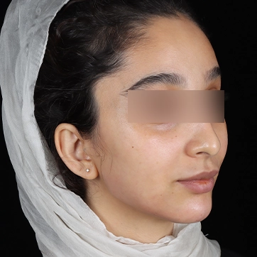 زاویه سازی صورت