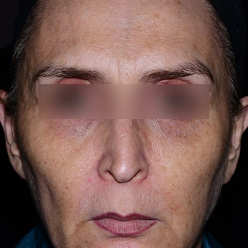 لیفت پیشانی (لیفت اندوسکوپیک)