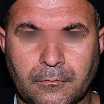 لیفت پیشانی