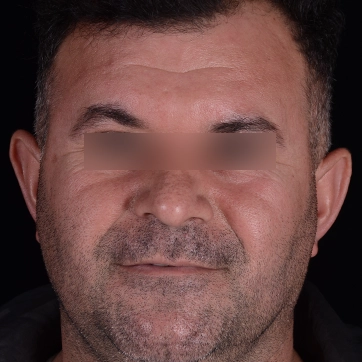 لیفت پیشانی