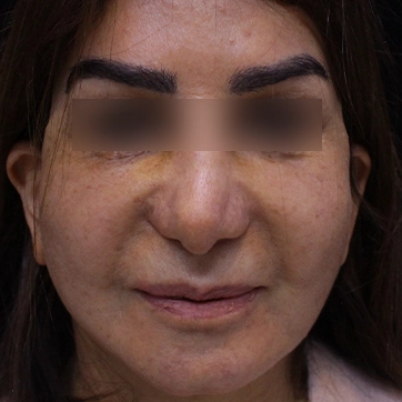 لیفت پیشانی