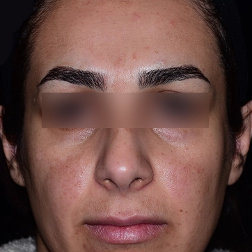 لیفت پیشانی