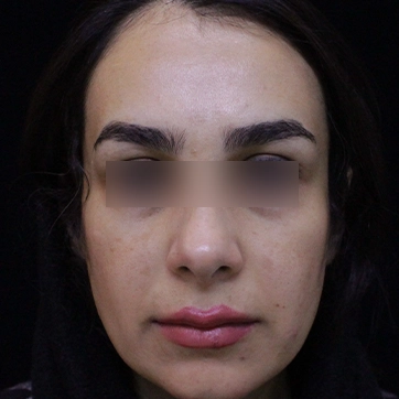 لیفت پیشانی