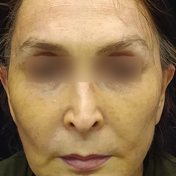 لیفت پیشانی (لیفت اندوسکوپیک)