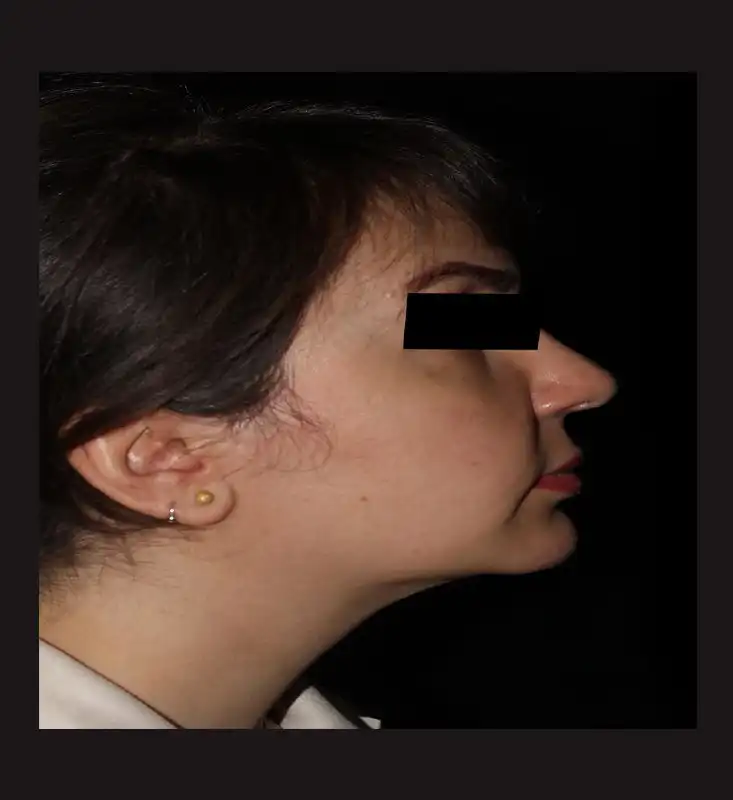 لیپوماتیک غبغب