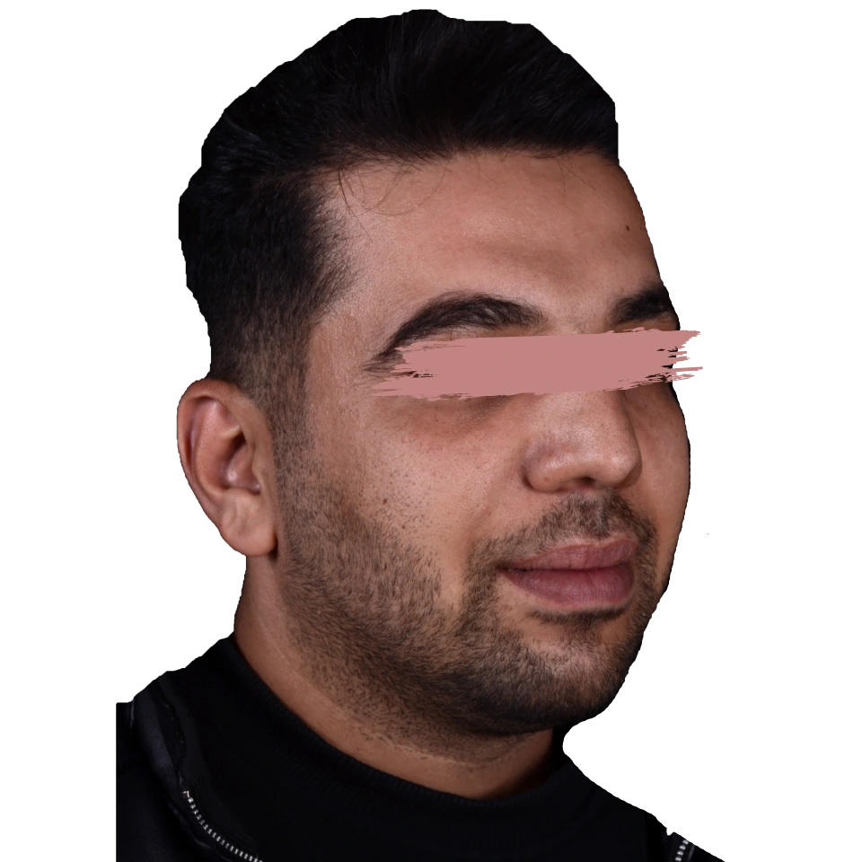 عمل کوچک کردن دهان