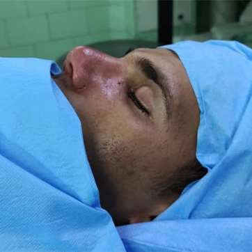 عمل جراحی بینی