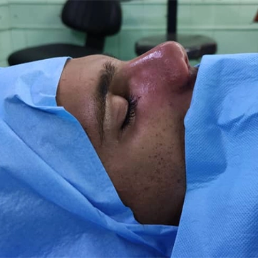 عمل جراحی بینی
