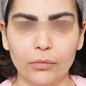 عمل لیفت شقیقه