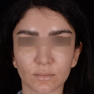 عمل لیفت شقیقه