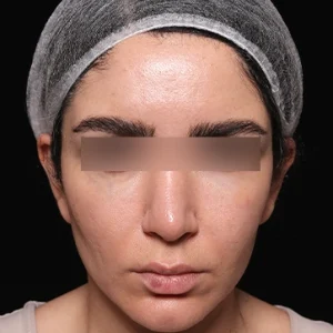 عمل لیفت شقیقه