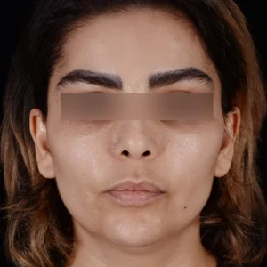 عمل لیفت شقیقه