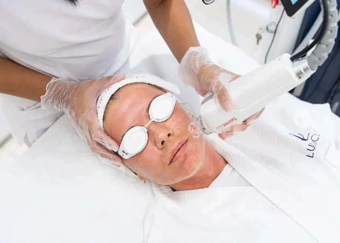 ماندگاری لیفت صورت با لیزر