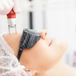 ماندگاری لیفت صورت با لیزر چقدر است؟