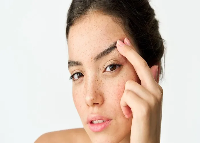 جای بخیه لیفت شقیقه