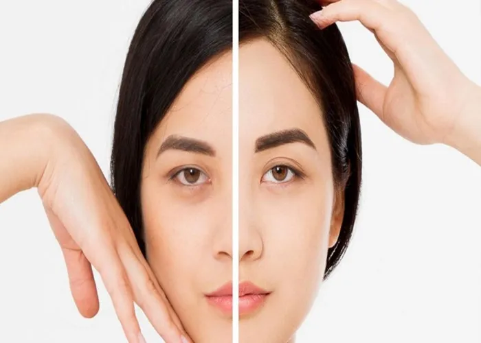 جای بخیه لیفت شقیقه