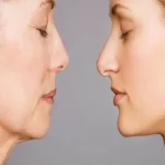 تفاوت لیفت صورت و لیفت گردن: کدام مناسب تر است؟