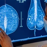 آیا پروتز سینه و ماموگرافی دیجیتال با هم تداخل دارند؟