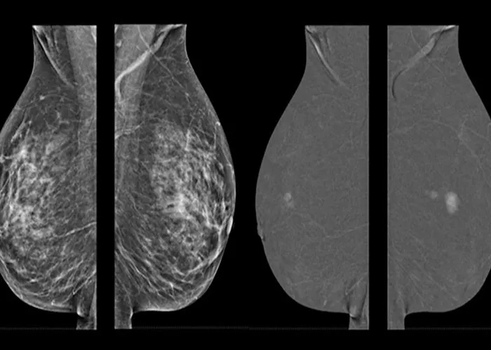 پروتز سینه و ماموگرافی دیجیتال